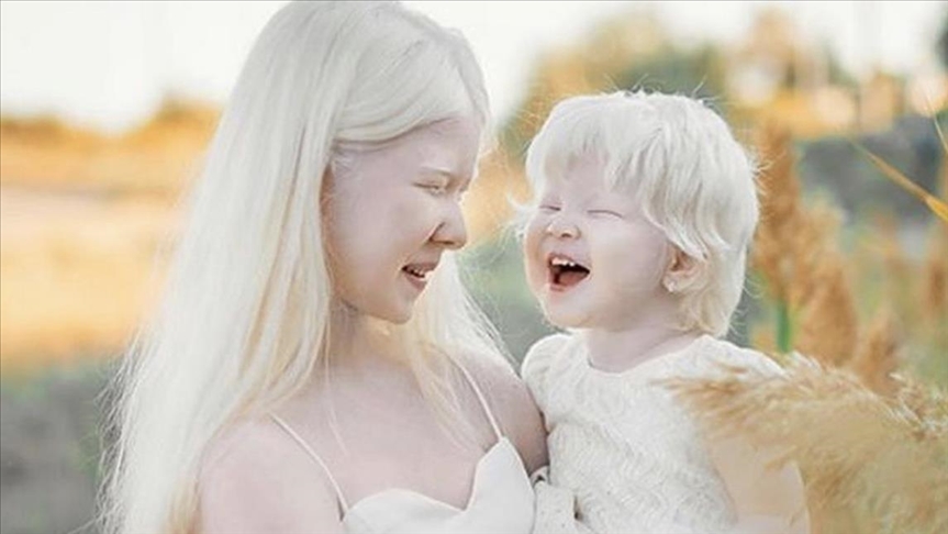 Kazakhstan's 'white princesses', sisters with albinism, shine in fashion world