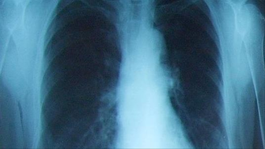 Rising lung cancer cases serious problem in India