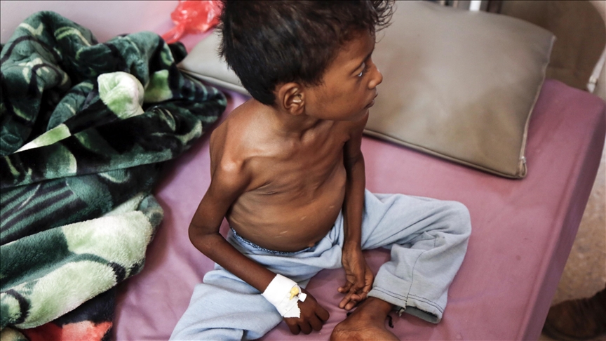 WHO upozorio da je tri četvrtine djece u Jemenu neuhranjeno