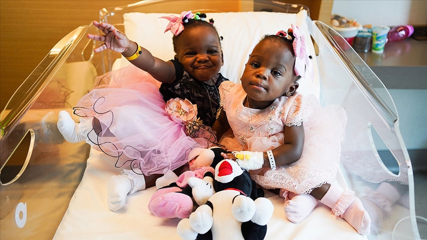 Kamerunda dünyaya gelen yapışık siyam ikizleri, Türkiyede şifa buldu