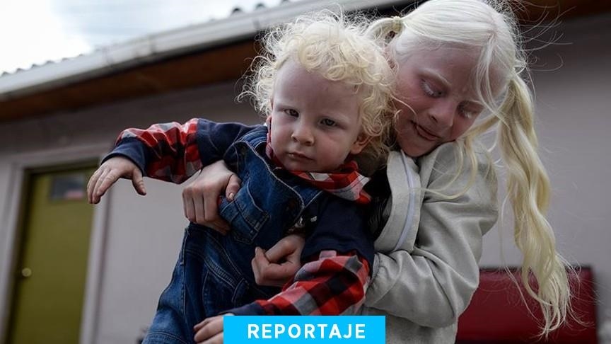 La población albina en Colombia busca más empatía y romper con estigmas 