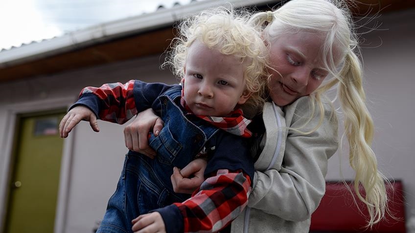 La población albina en Colombia busca más empatía y romper con estigmas 