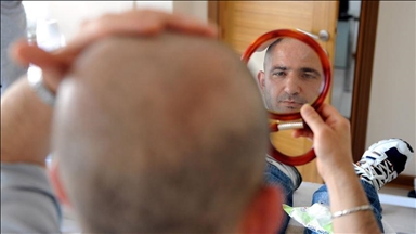 الأوروبيون يشكّلون 70 بالمئة رواد زارعة الشعر في تركيا