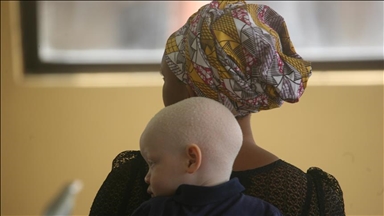 En RDC, la survie difficile des albinos
