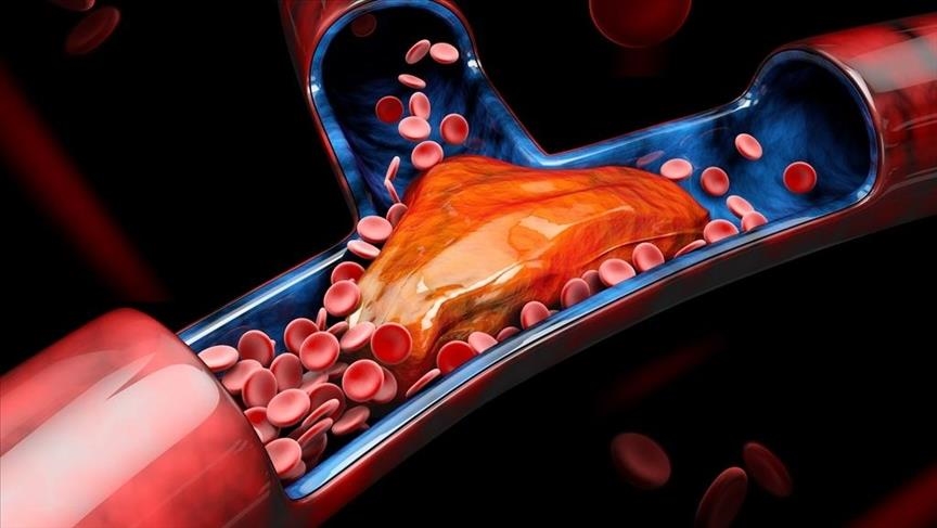 Turkish technology offers effective treatment for deep vein thrombosis