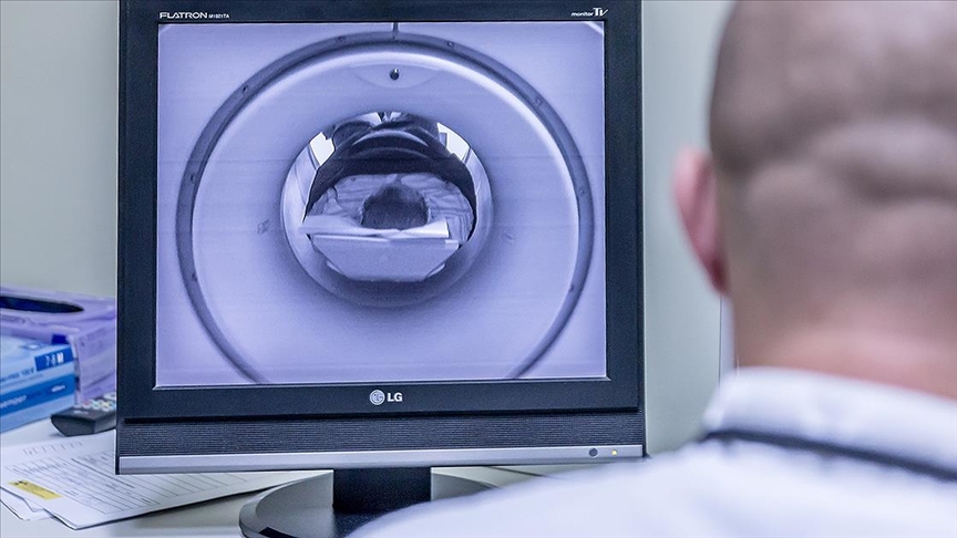 'Nearly 500,000 people suffer brain aneurysms each year'