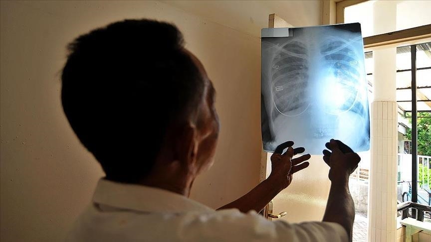  Tuberculosis becomes deadliest infectious diseases worldwide after COVID in 2021