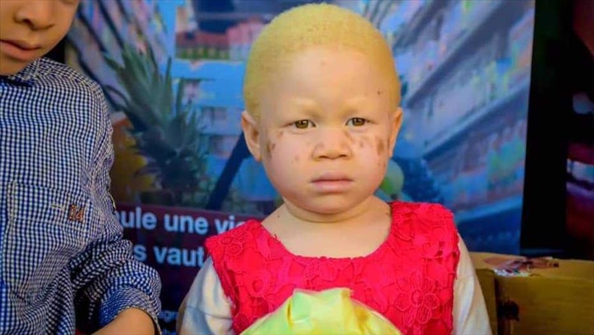 RD Congo : La lutte des albinos pour leur reconnaissance