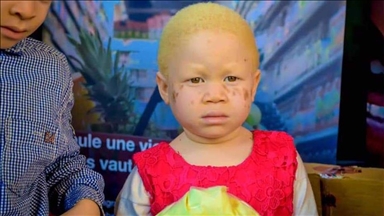 RD Congo : La lutte des albinos pour leur reconnaissance