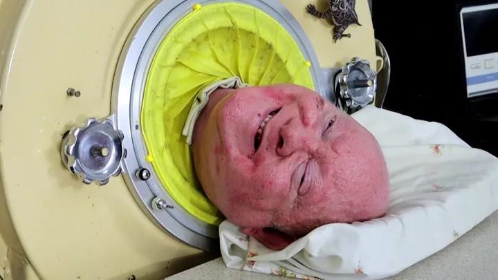 American living in an iron lung for more than 70 years dies after contracting coronavirus