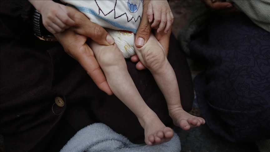 شمالي غزة.. الجوع والمرض ينهش جسد الرضيعة جنيد