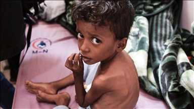 السعودية تقدم 4.85 ملايين دولار لمكافحة سوء التغذية باليمن