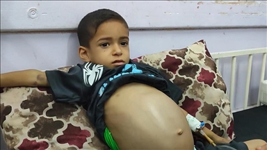 Gazze’de karaciğer ve dalak büyümesi olan 9 yaşındaki Emin, imkansızlıklar yüzünden tedavi olamıyor