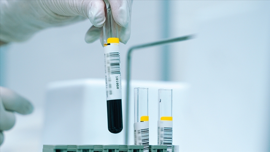 Talasemide geç tedavi en sık kalp hastalığından ölüme neden oluyor