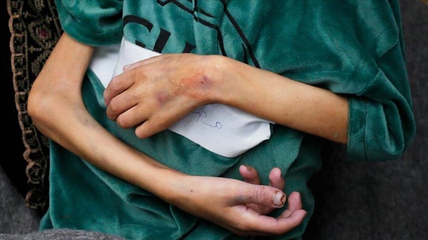 U sedam dana u Gazi od posljedica gladi umrlo još četvero djece