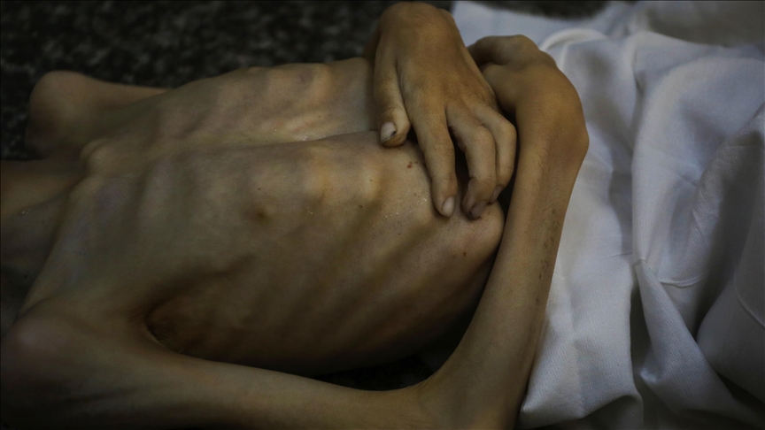 6-year-old boy dies of malnutrition in Gaza amid Israeli blockade