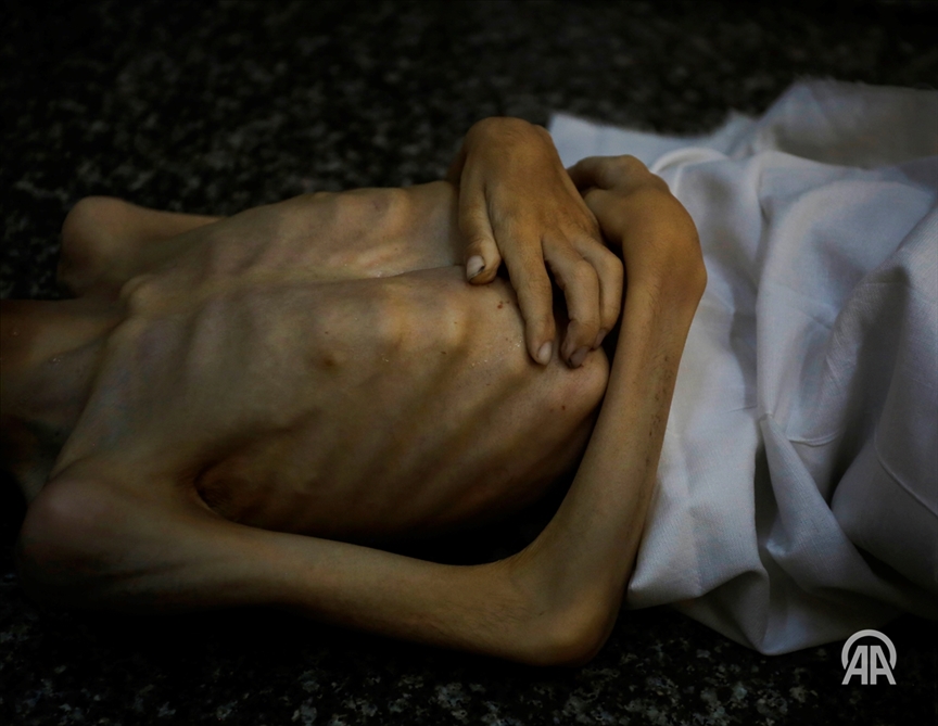 Un niño de seis años muere por desnutrición en Gaza debido al bloqueo implementado por Israel