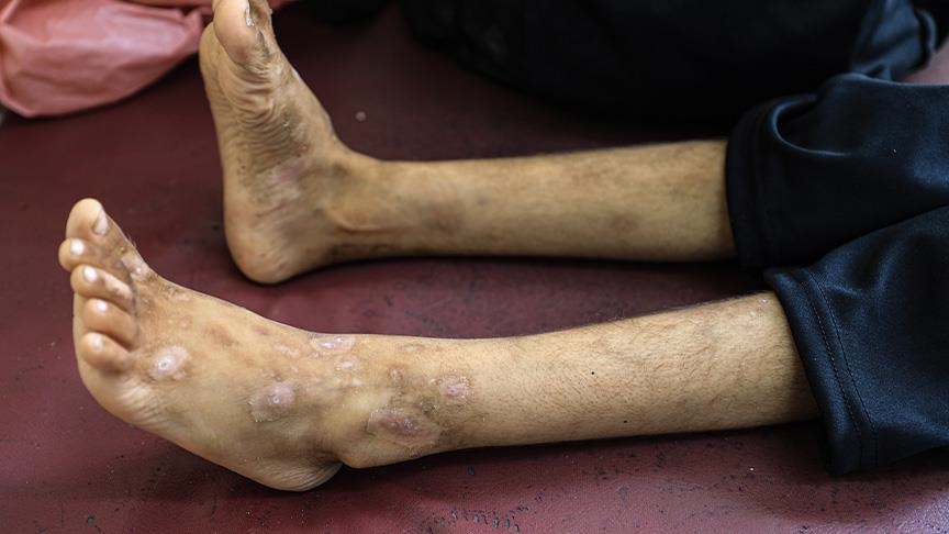 أمراض جلدية تفتك بأطفال نازحين في غزة (تقرير)
