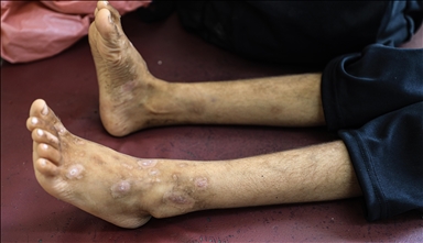 Slučajevi kožnih bolesti šire se među djecom u Gazi