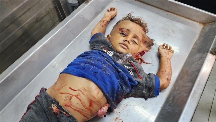 الفتى أنس عبيد.. نجا من مجزرة "التابعين" ويعاني من حرق نصف جسمه