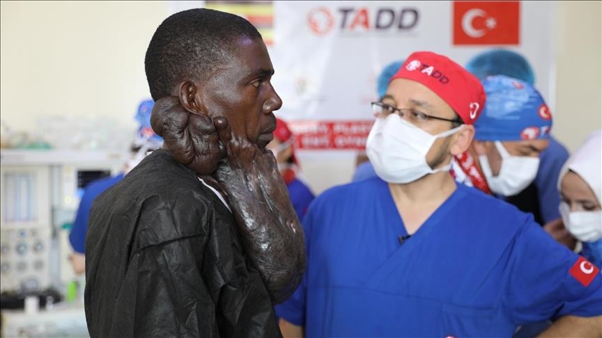 Turkish doctors remove 5-kilogram keloid mass from Ugandan patient