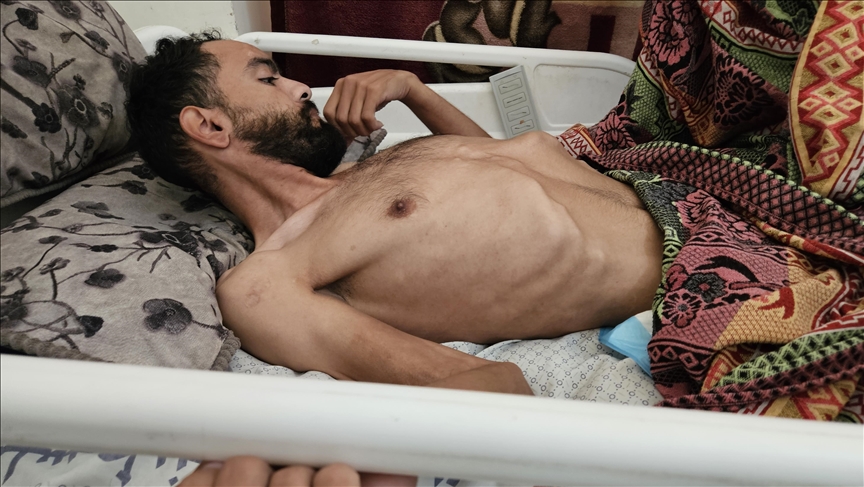 Malnutrition kills elderly Palestinian, 17 children hospitalized amid Israeli siege on northern Gaza