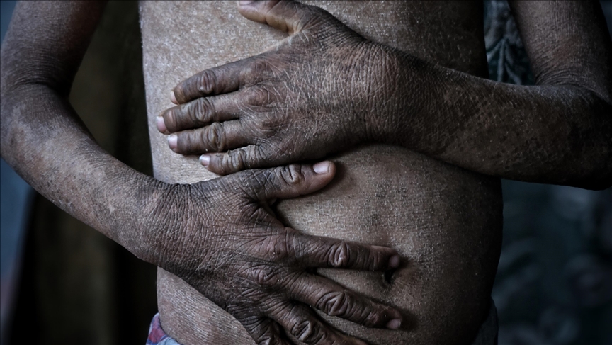 Gaza authorities warn of spread of diseases among displaced civilians amid Israeli assault