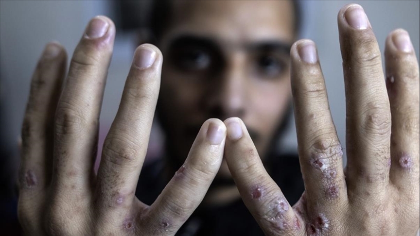 حماس: الأسرى المحررون تعرضوا لتعذيب حتى قبيل إطلاق سراحهم