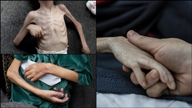 İsrail ablukası nedeniyle yetersiz beslenen Gazzeli çocukların üzerinde "ölüm" kol geziyor
