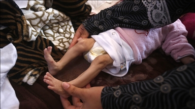 Israel’s cruel starvation policy in Gaza turns Palestinian baby into ‘skeleton’