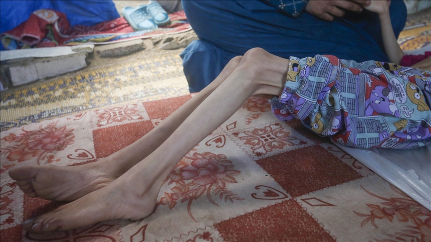 UK-based Israeli advocacy group facing backlash for saying Gaza war may reduce obesity