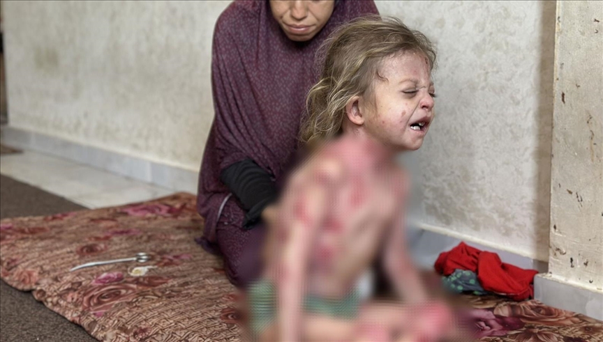 Vogëlushja Nur nga Gaza e cila vuan nga një sëmundje e rrallë po pret për trajtim