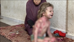 Vogëlushja Nur nga Gaza e cila vuan nga një sëmundje e rrallë po pret për trajtim