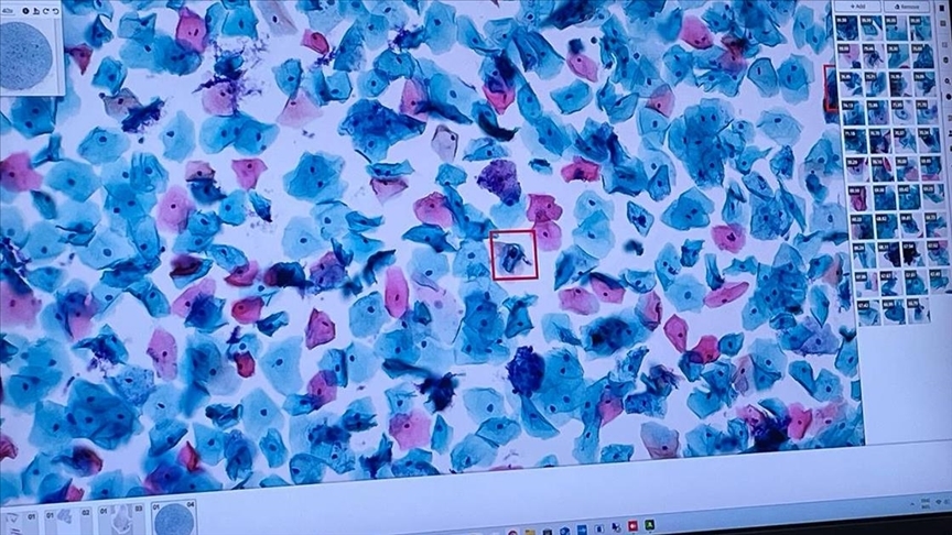 Yapay zeka kanserin erken teşhis ve tedavisinde önemli rol oynuyor
