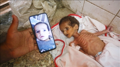 Gaza : 66 enfants morts de malnutrition aiguë depuis octobre 2023
