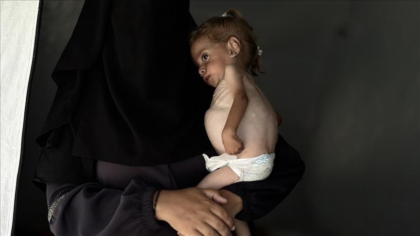 شام قدیح، دختربچه غزهای به دلیل محاصره اسرائیل از سوءتغذیه حاد رنج میبرد