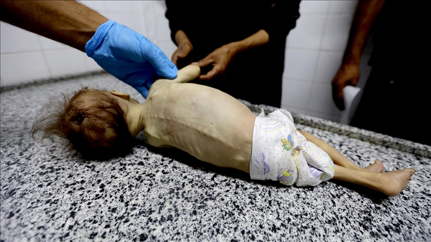 Gazan baby dies of malnutrition, twin fights to survive under Israeli siege