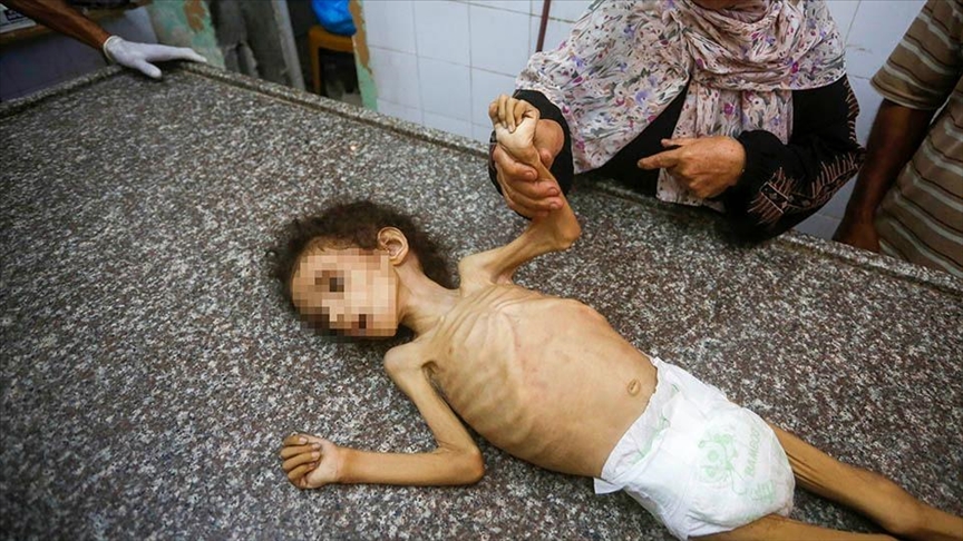 Gaza : une fillette de 4 ans meurt de malnutrition dans un contexte de blocage de l’aide humanitaire par Israël