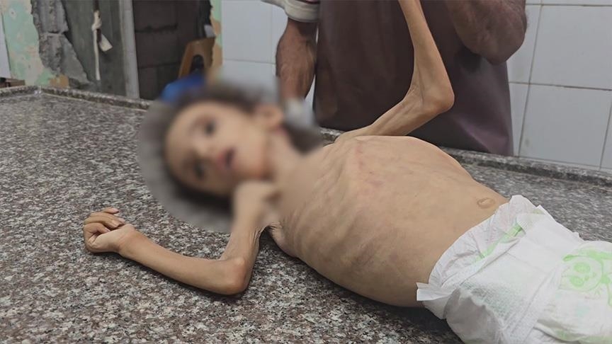 رزان تموت جوعا... طفلة أخرى تُزهَق روحها بسبب تجويع إسرائيل للفلسطينيين بغزة