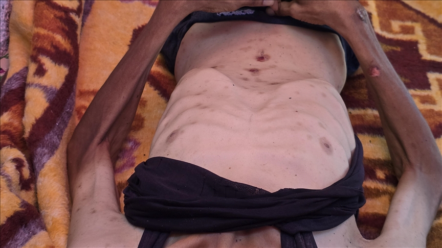 Starvation kills 15 Gazans, including 4 children, in last 24 hours: Health Ministry