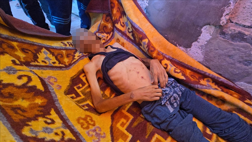 غزة تموت جوعا.. وفاة مريض فلسطيني متأثرا بسوء التغذية