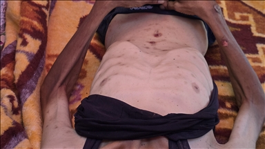 Starvation kills 15 Gazans, including 4 children, in last 24 hours: Health Ministry