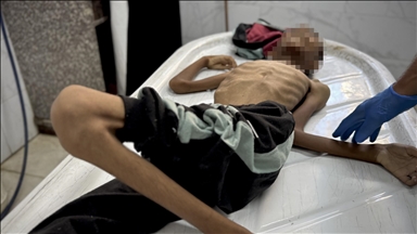 غزة تموت جوعا.. وفاة 15 فلسطينيا بسوء التغذية خلال 24 ساعة