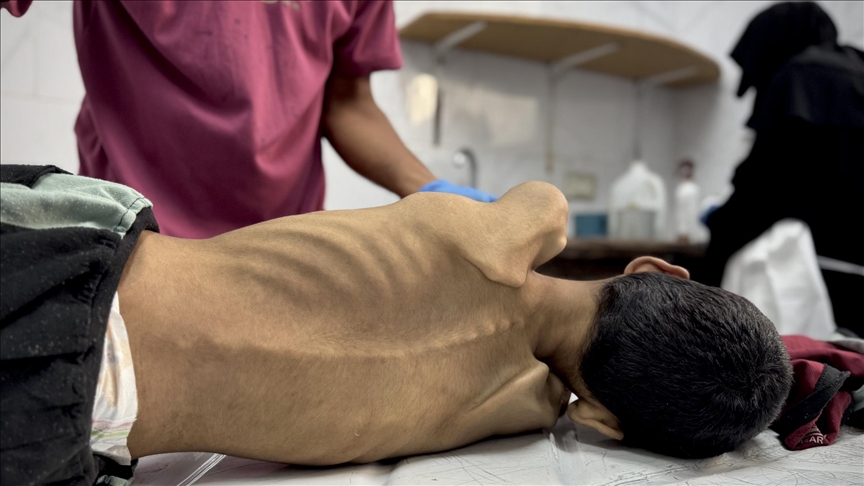 الأورومتوسطي: وفاة أكثر من 60 طفلا بغزة جراء سوء التغذية منذ مارس