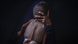 Gaza faces imminent mass death of 100,000 children amid baby formula shortage