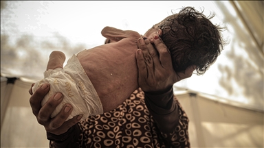 6 more Gazans, including 2 children, die from starvation amid Israeli siege