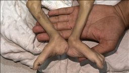 İsrail'in kıtlığı dayattığı Gazze'de son 24 saatte 2'si çocuk 6 Filistinli açlıktan hayatını kaybetti