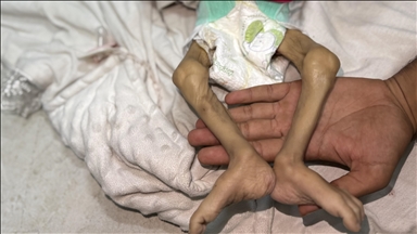 İsrail'in açlık ve kıtlığı dayattığı Gazze Şeridi'nde son 24 saatte 1'i çocuk 14 Filistinli açlıktan hayatını kaybetti