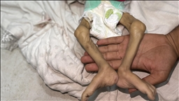 İsrail'in açlık ve kıtlığı dayattığı Gazze Şeridi'nde son 24 saatte 1'i çocuk 14 Filistinli açlıktan hayatını kaybetti