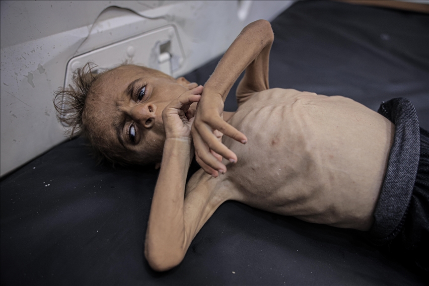 Fotografija jednoipogodišnjeg Mohammada razotkriva izraelsku politiku izgladnjivanja